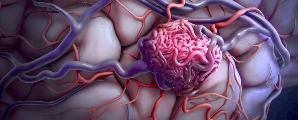 Aneurysms & AVMs