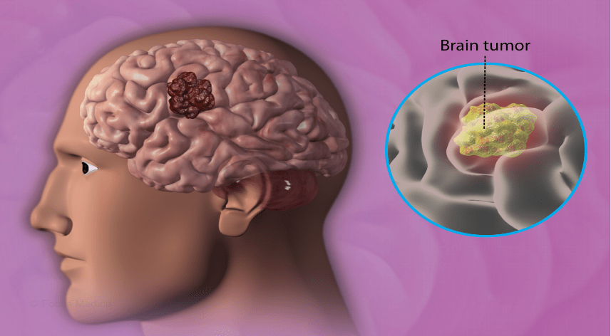 Brain Tumor