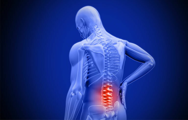Low Back Pain
