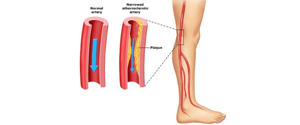Neurological vs. Vascular Claudication