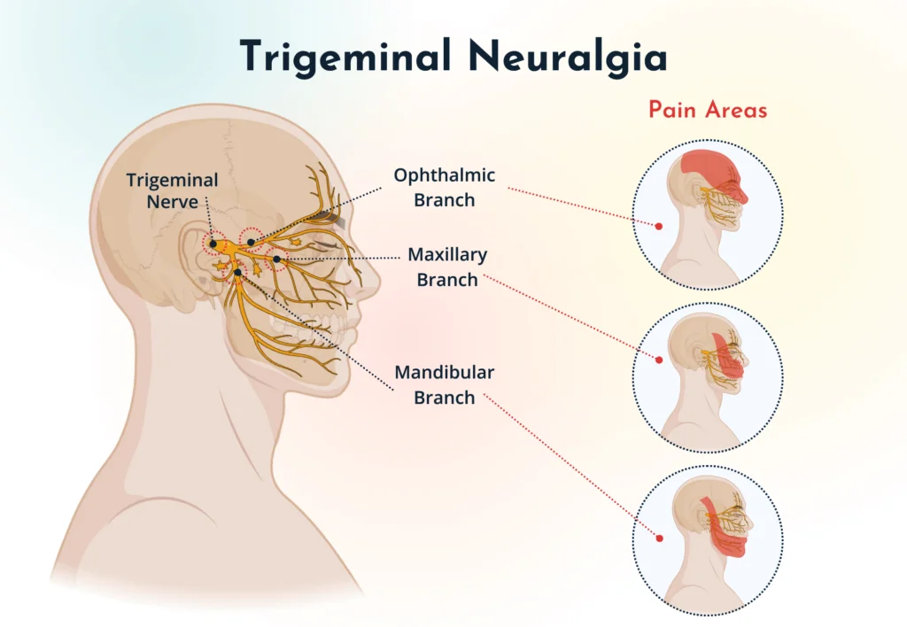 Calm Down Trigeminal Neuralgia