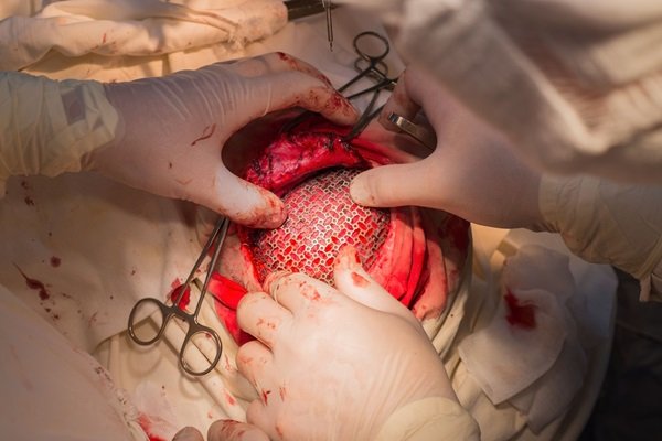 Brain Tumor Surgeon