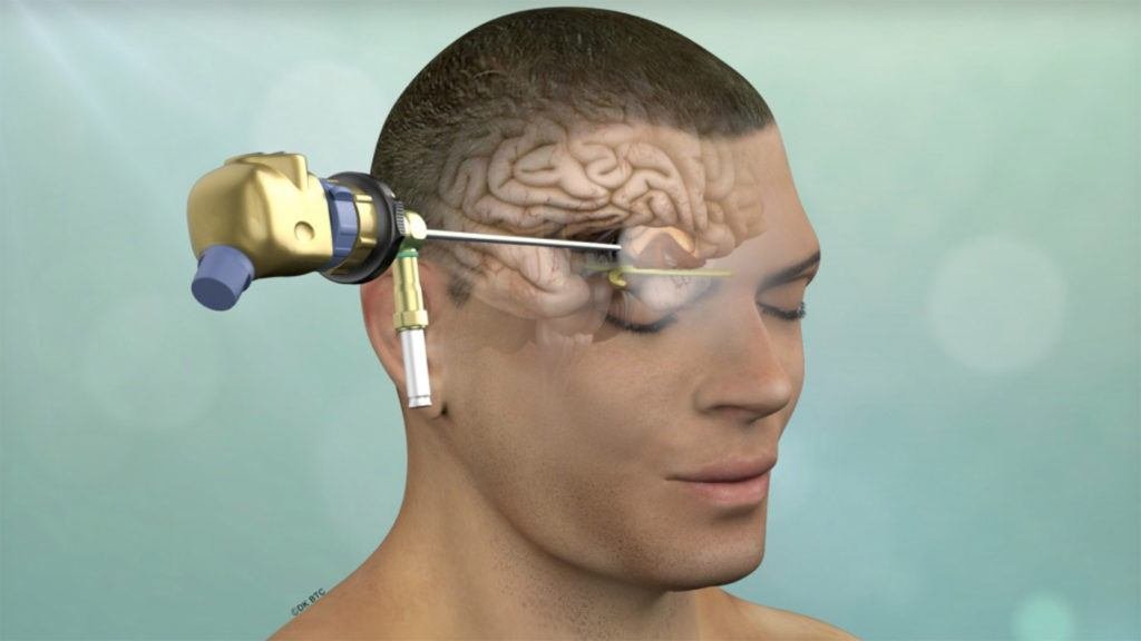 Minimally Invasive Brain Surgery vs Traditional Surgery